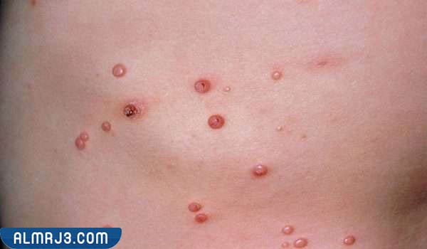 العلاجات التقنية والكيميائية للمليساء المعدية