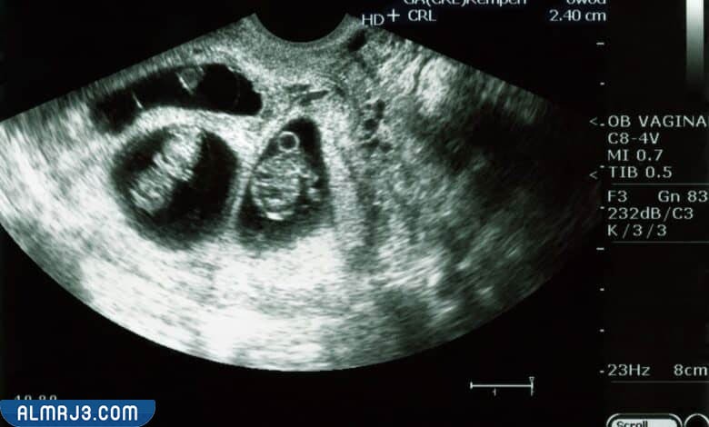 نصائح للحامل بتوأم في الأسبوع الأول