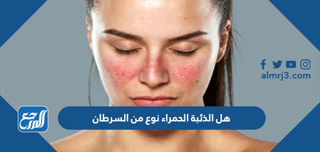 هل الذئبة الحمراء نوع من السرطان