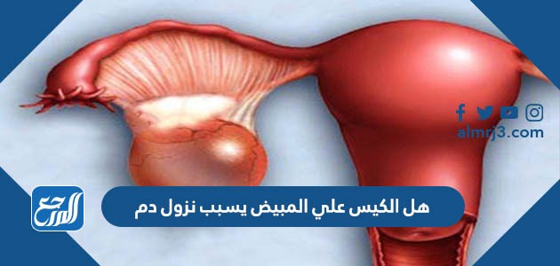 هل الكيس علي المبيض يسبب نزول دم