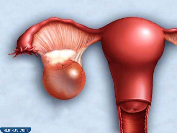 هل يحدث حمل مع وجود كيس على المبيض 