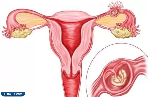 متى تبدأ أعراض الحمل خارج الرحم بالظهور؟