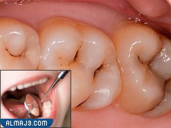 نصائح للوقاية من الإصابة بتسوس الأسنان 
