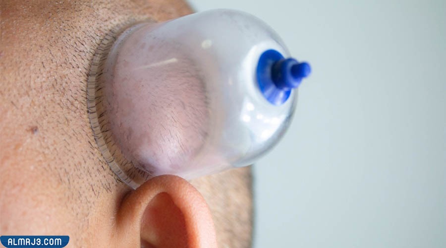 أثر استخدام الحجامة لمرضى التهاب الأذن الوسطى 