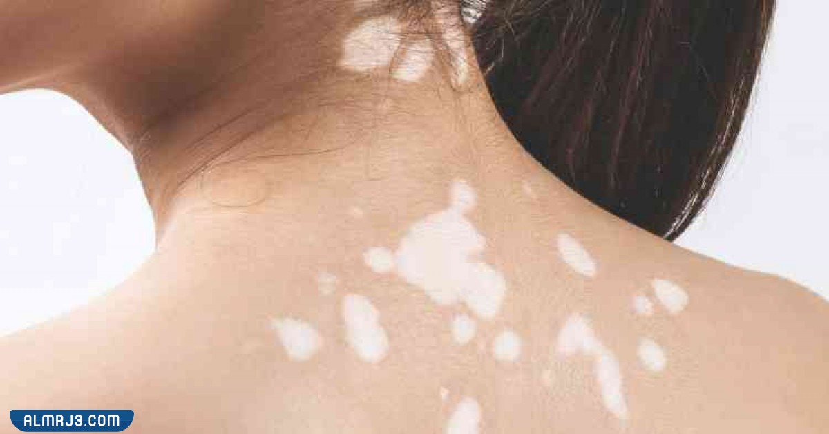 أسباب الإصابة بمرض البهاق 