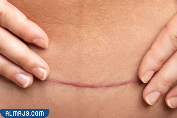 أسباب التهاب جرح العملية القيصرية 