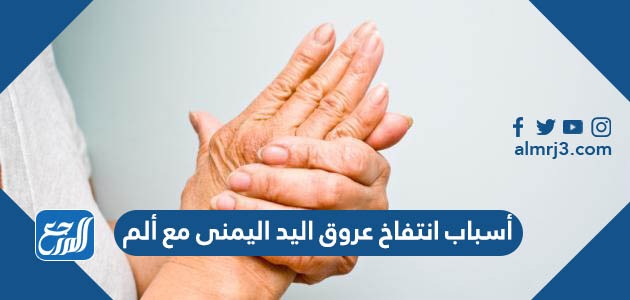 أسباب انتفاخ عروق اليد اليمنى مع ألم