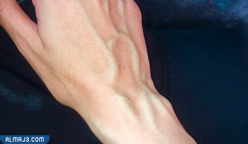 أسباب بروز عروق اليدين