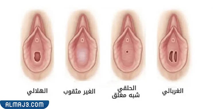 أنواع غشاء البكارة