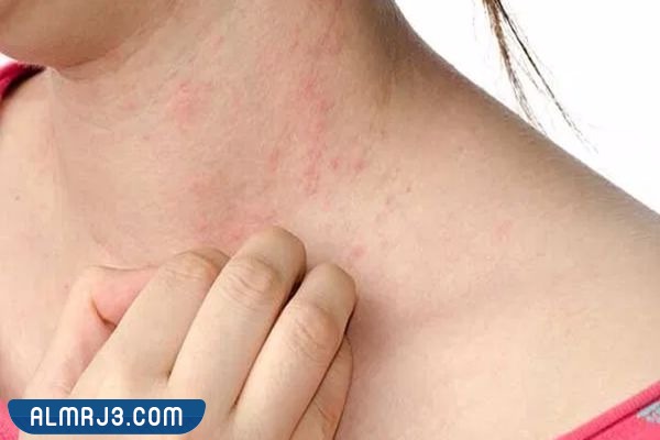 أنواع الفطريات 