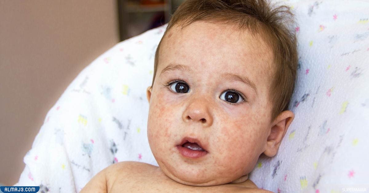 البهاق عند الأطفال بالصور 
