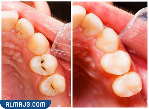 التخلص من تسوس الأسنان بالوصفات الطبيعية 