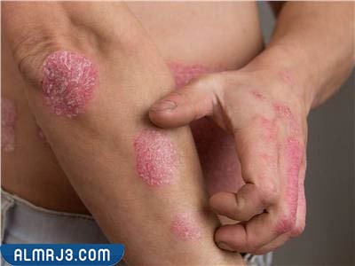 حساسية التهاب الجلد التماسي 