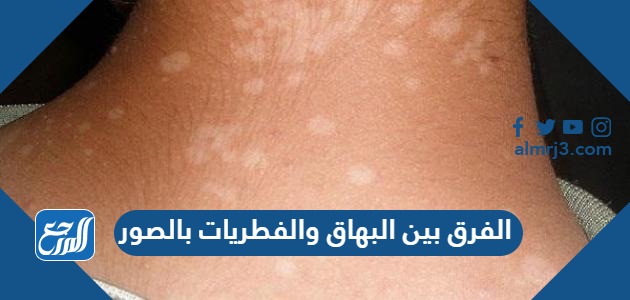 الفرق بين البهاق والفطريات بالصور