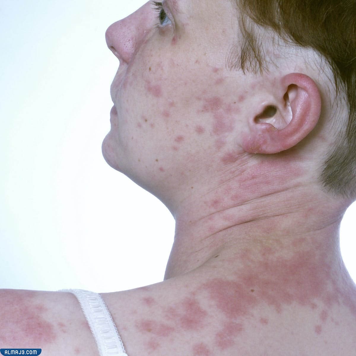 حساسية الوذمة الوعائية 