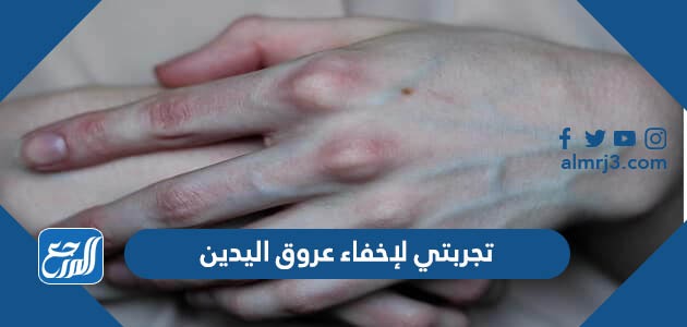 تجربتي لإخفاء عروق اليدين