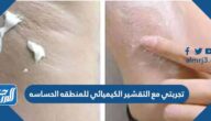 تجربتي مع التقشير الكيميائي للمنطقه الحساسه