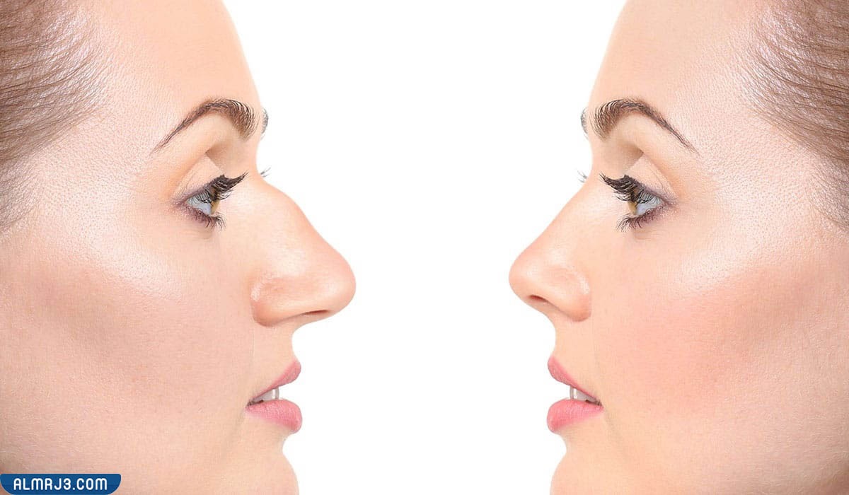 تجربتي مع عملية تجميل الأنف