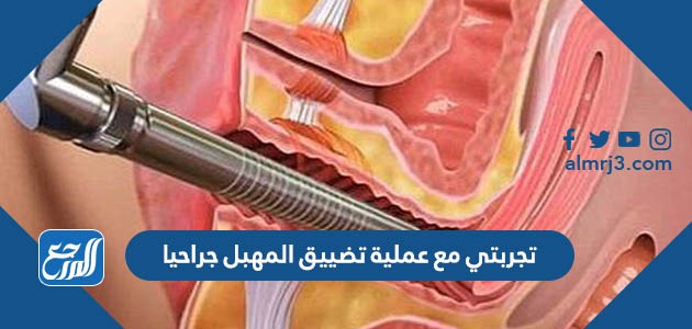 تجربتي مع عملية تضييق المهبل جراحيا