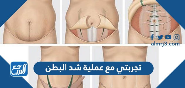 تجربتي مع عملية شد البطن