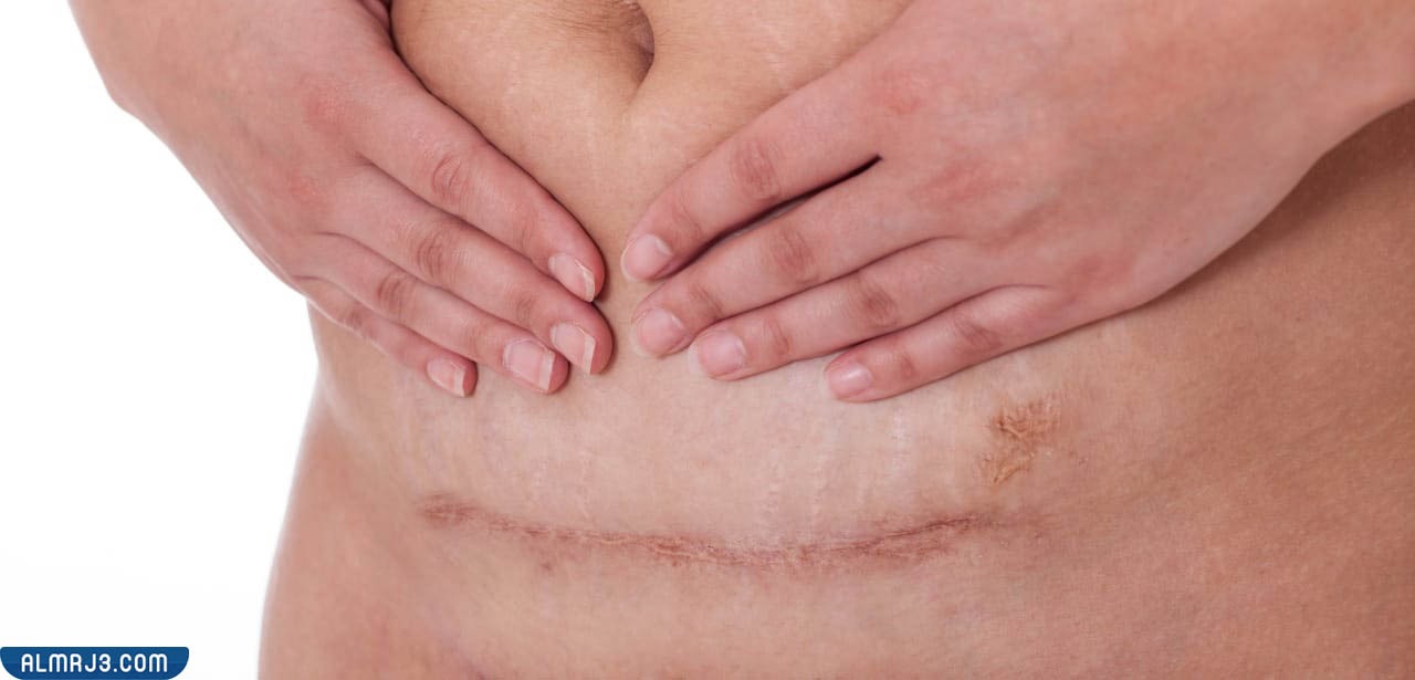 جرح العملية القيصرية يحرقني 