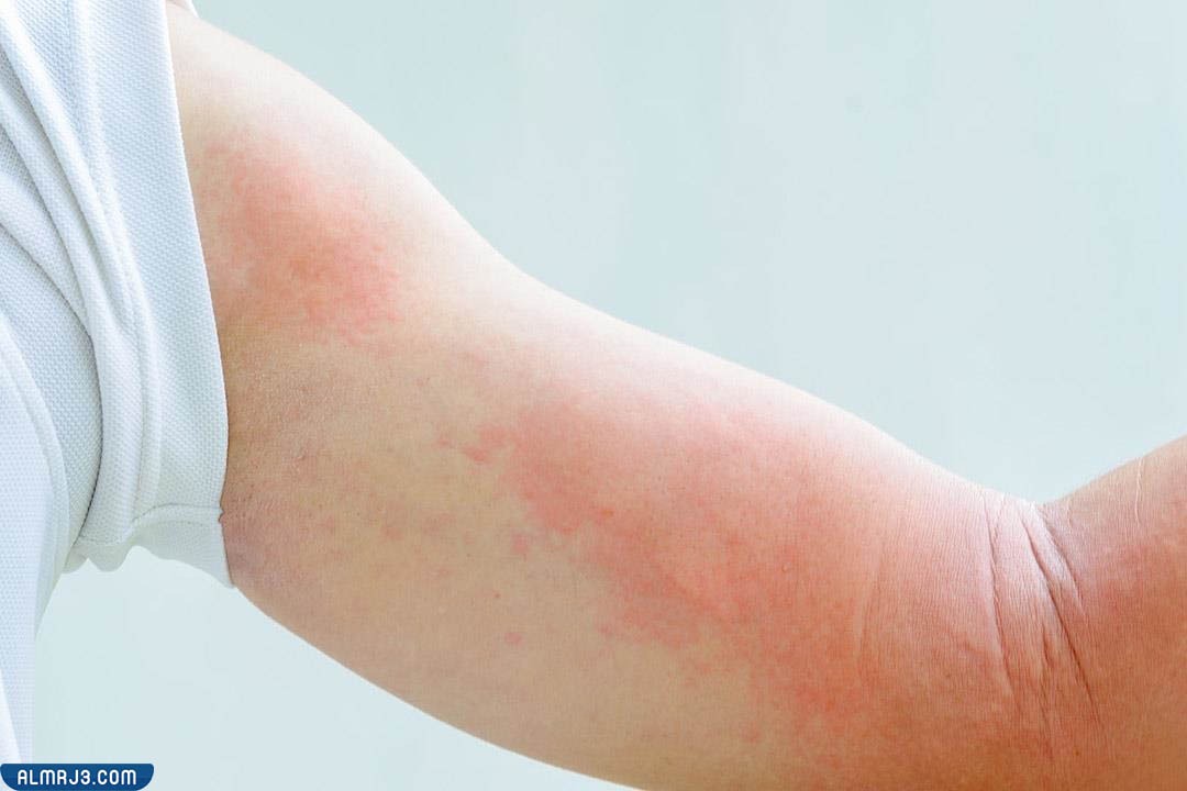 حساسية الأكزيما 