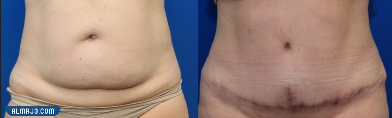 شد البطن بعد الولادة القيصرية بالصور