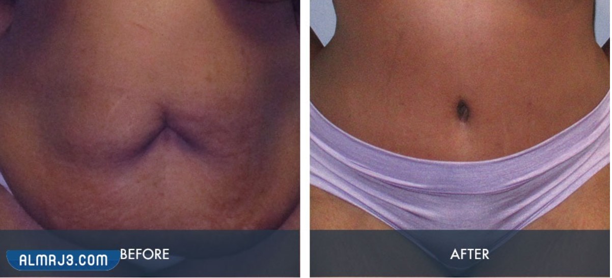 شد البطن بعد الولادة القيصرية بالصور