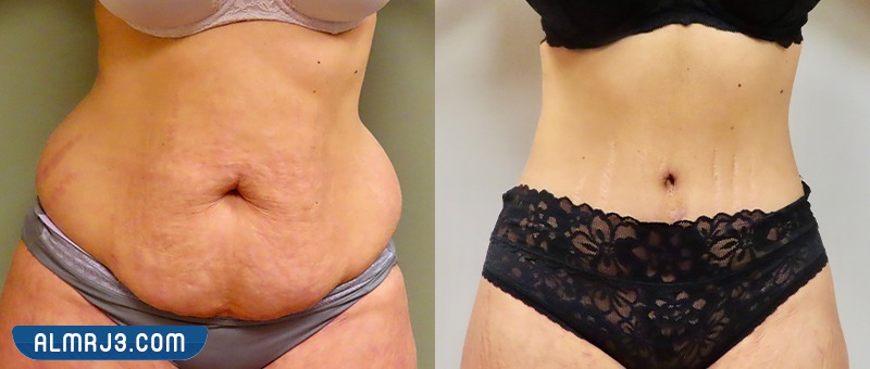 شد البطن بعد الولادة القيصرية بالصور