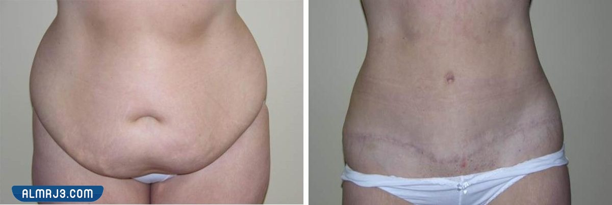 شد البطن بعد الولادة القيصرية بالصور