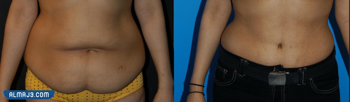 شد البطن بعد الولادة القيصرية بالصور