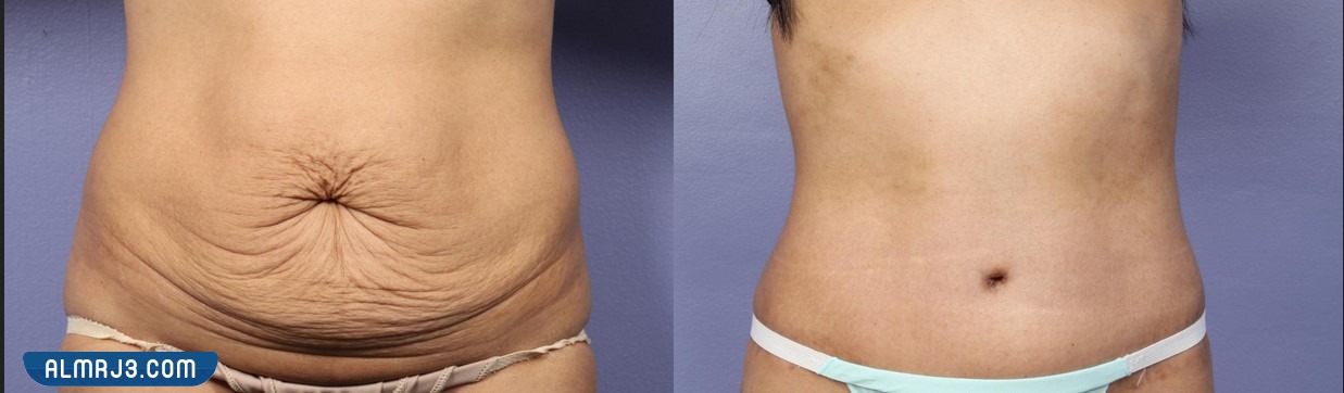 شد البطن بعد الولادة القيصرية بالصور
