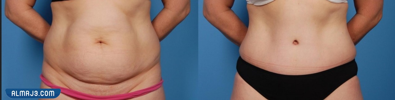 شد البطن بعد الولادة القيصرية بالصور