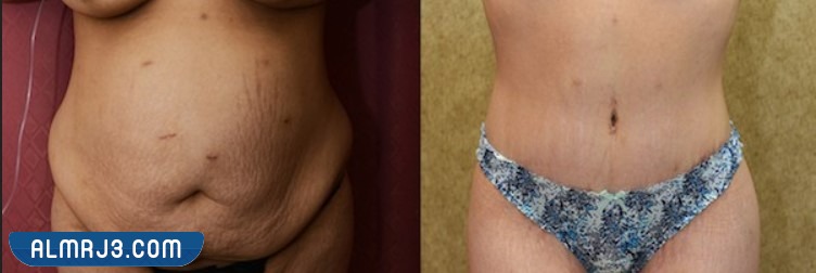 شد البطن بعد الولادة القيصرية بالصور