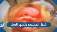 شكل المشيمه بالشهر الاول من الحمل بالصور