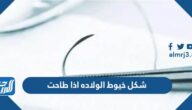 شكل خيوط الولاده اذا طاحت