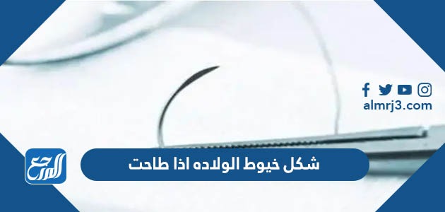 شكل خيوط الولاده اذا طاحت