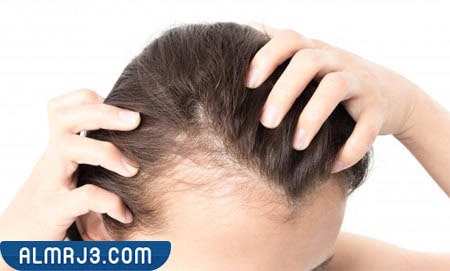 طرق علاج الصلع الوراثي 