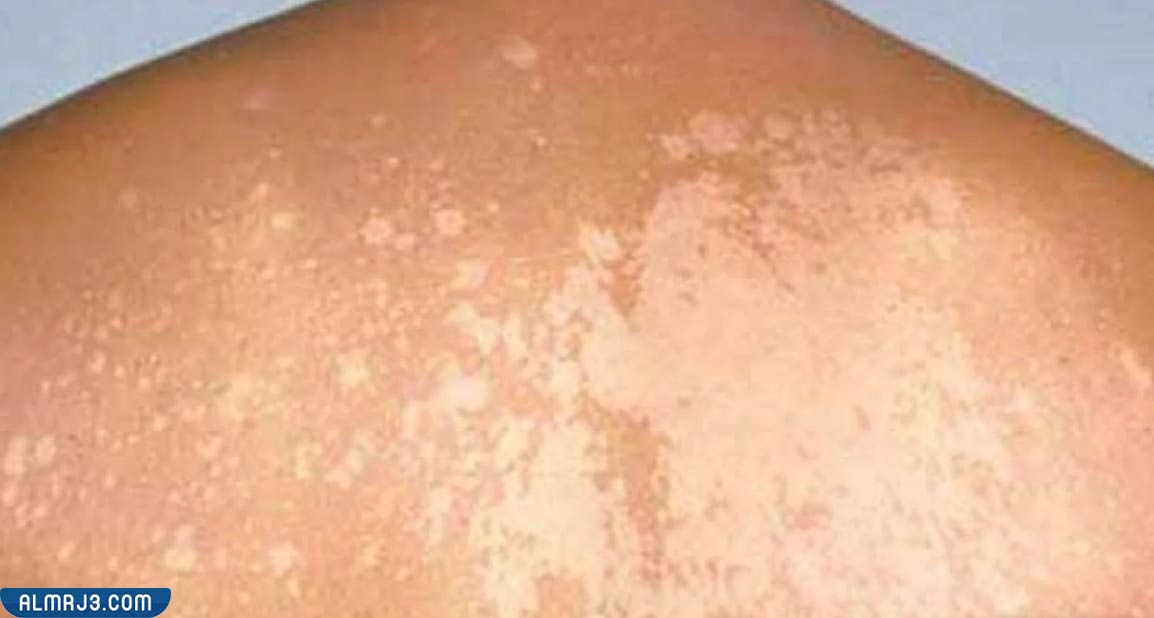 فطريات الجلد البيضاء بالصور 