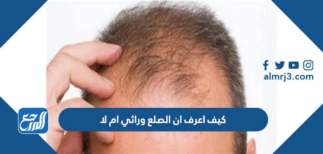 كيف اعرف ان الصلع وراثي ام لا