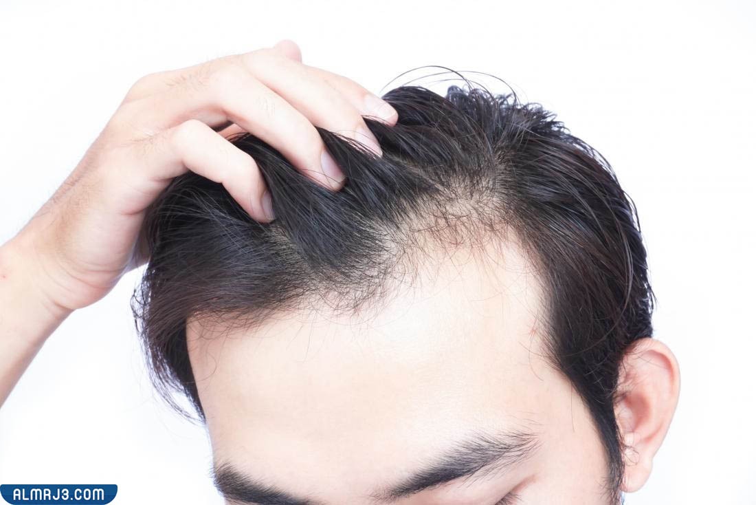 كيف تعرف أنك سوف تصبح أصلع 