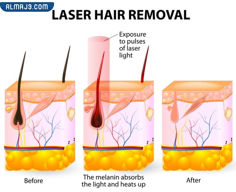 مميزات استخدام الليزر لإزالة الشعر