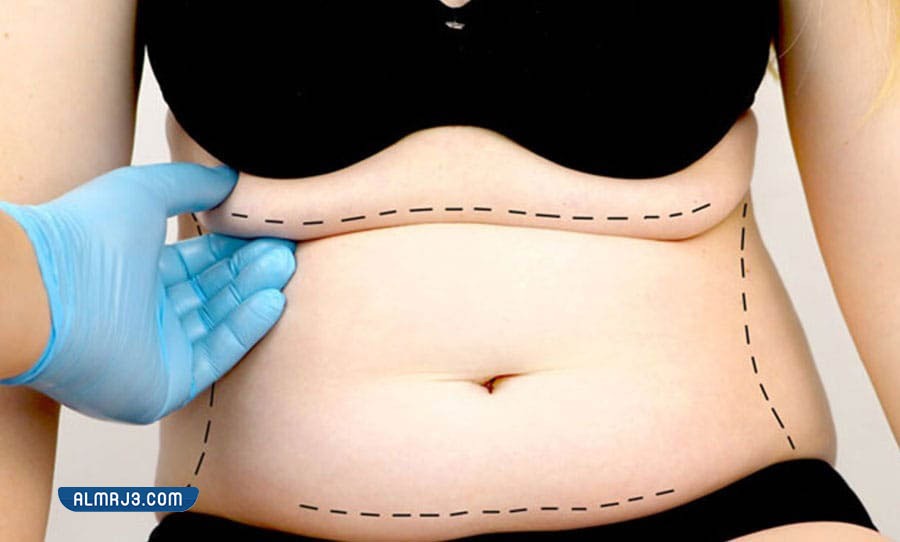 ما هي عملية شد البطن 