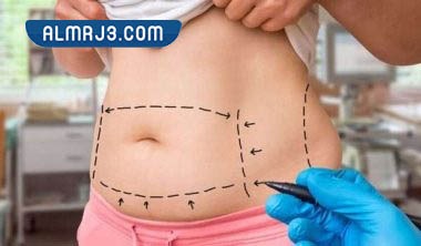 مدة الشفاء من عملية شد البطن 
