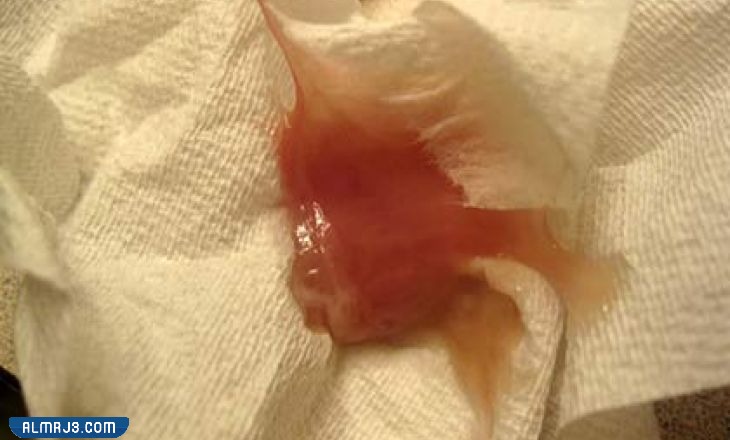 كيف اعرف ان سدادة الرحم نزلت