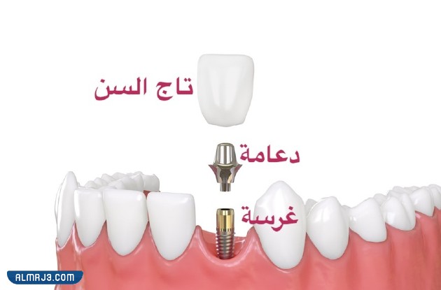 أسعار زراعة الأسنان الفورية في الرياض