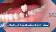 أسعار زراعة الأسنان الفورية في الرياض 2025