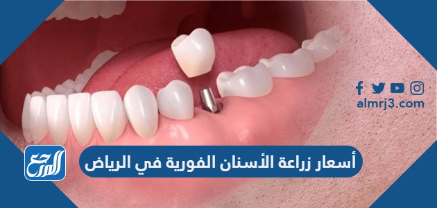 أسعار زراعة الأسنان الفورية في الرياض