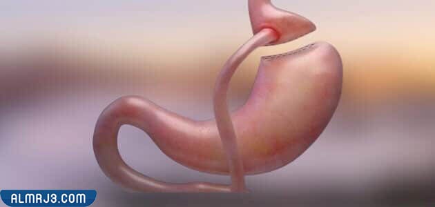 أضرار عملية تحويل مسار المعدة
