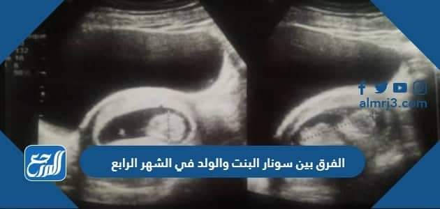 الفرق بين سونار البنت والولد في الشهر الرابع
